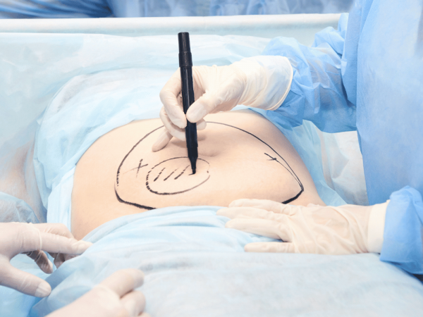 Liposuction operation. Doctor hands near belly